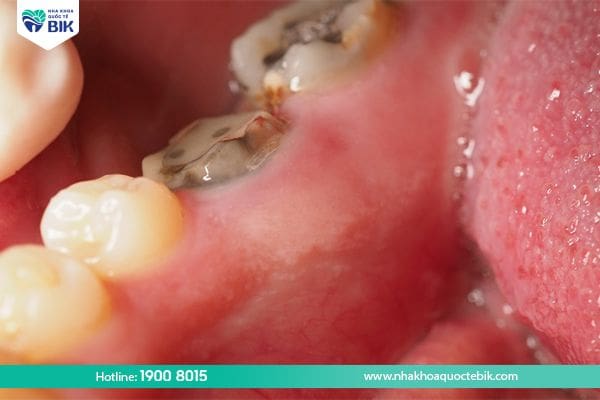 complications of tooth decay into the pulp