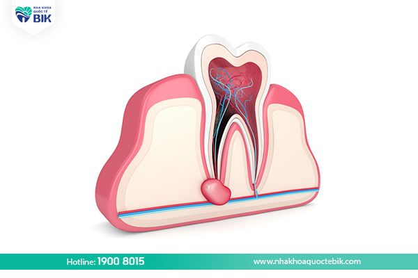 complications of tooth decay