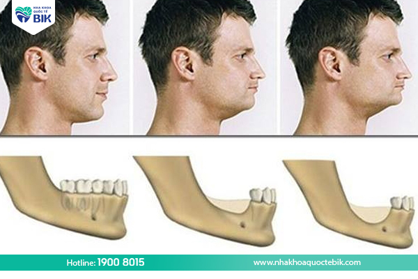 Tiêu xương hàm - Biến chứng mất răng lâu năm