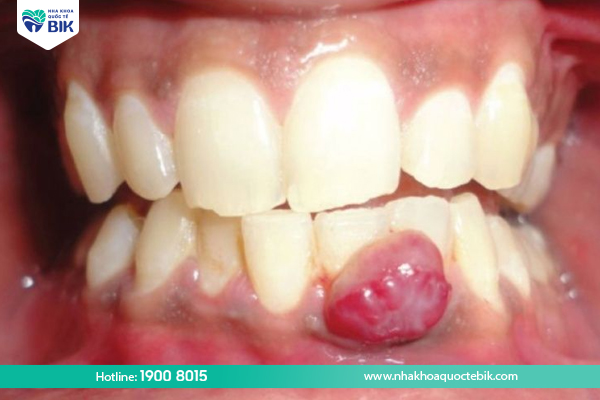 Complications of swollen gums