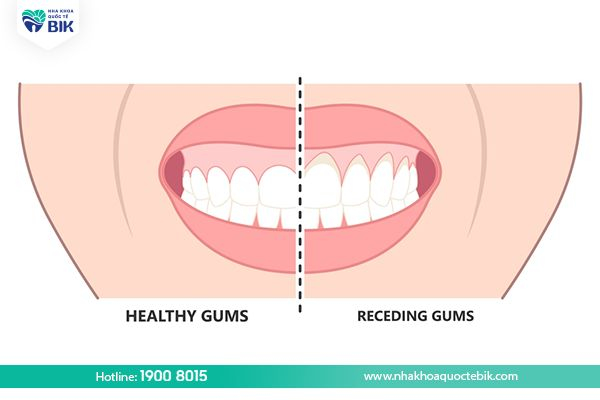 Symptoms of gum recession