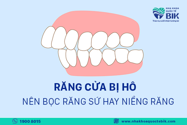 bọc răng sứ cho răng cửa bị hô hay nên niềng