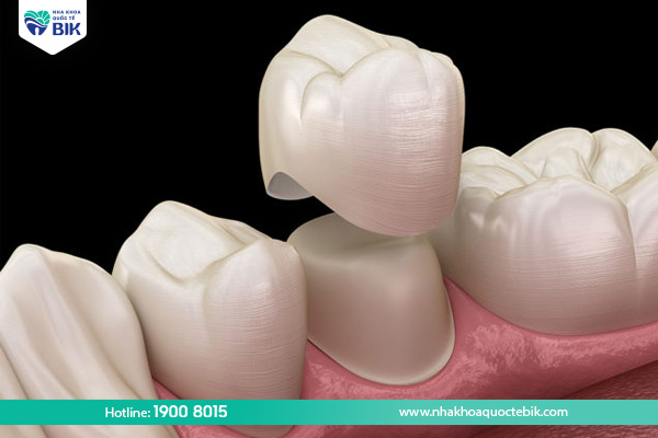 Porcelain crowns to treat tooth decay in adults