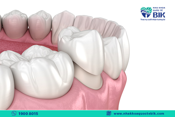 What is the effect of porcelain crowns