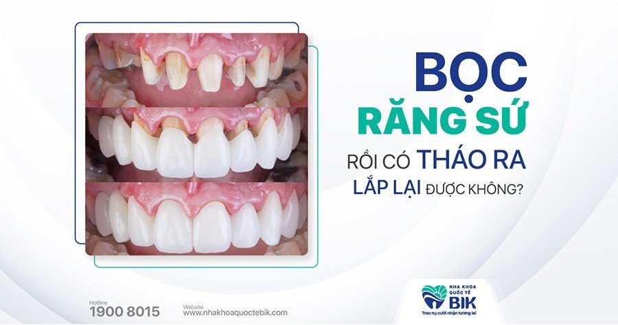 boc-rang-su-co-thao-ra-duoc-khong