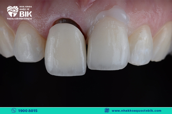 covering 2 protruding front teeth with porcelain