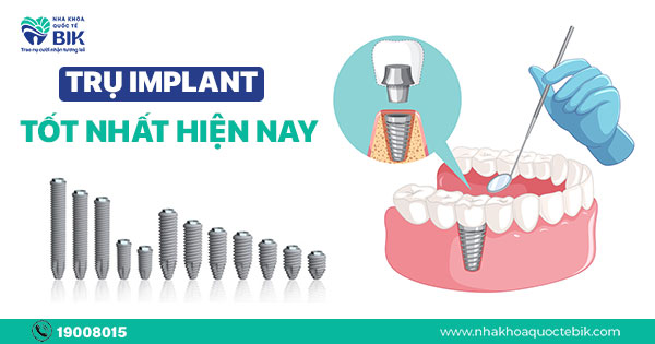 tru-implant-tot-nhat