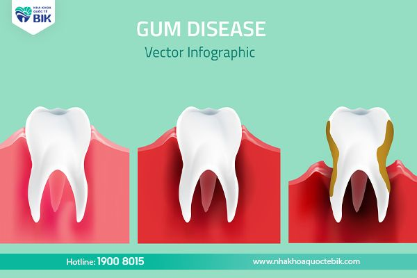 Các giai đoạn của bệnh viêm lợi