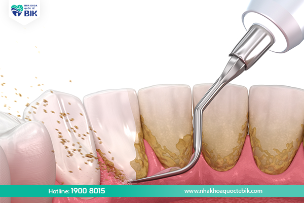 Scaling helps prevent bleeding gums