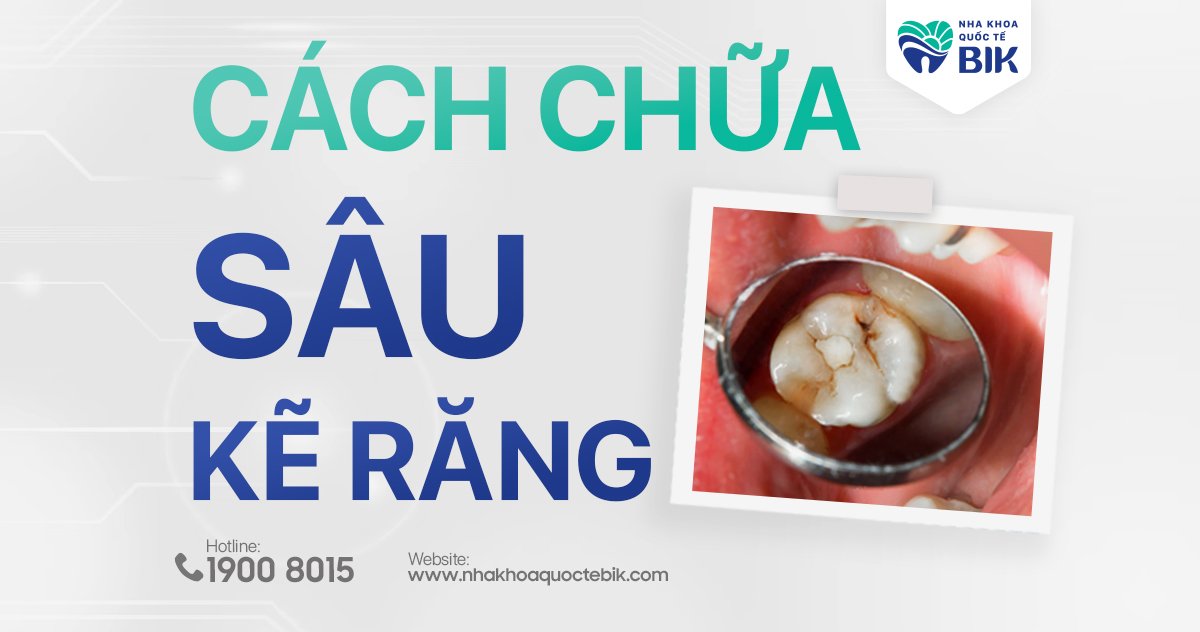 Cách chữa sâu kẽ răng