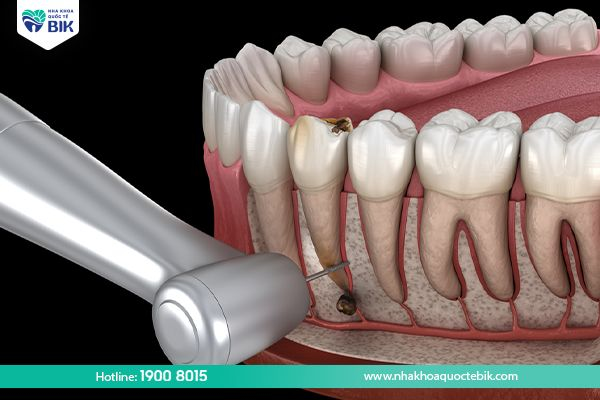 cách điều trị nang chân râng