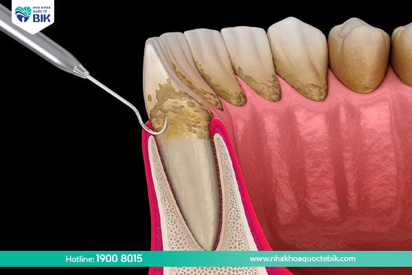 Scaling teeth to treat mild periodontitis