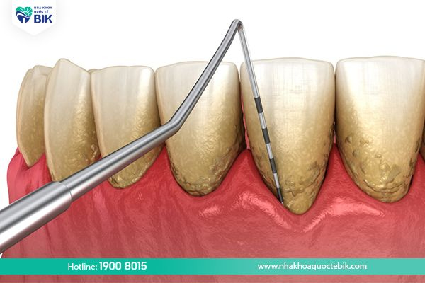 scraping teeth to treat periodontitis