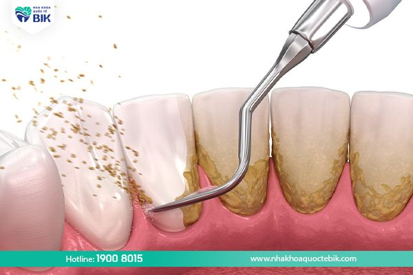 scraping to treat mild receding gums