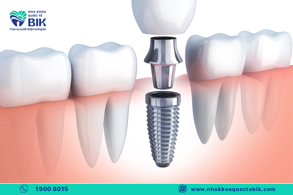 trong-rang-implant-va-cau-rang-su