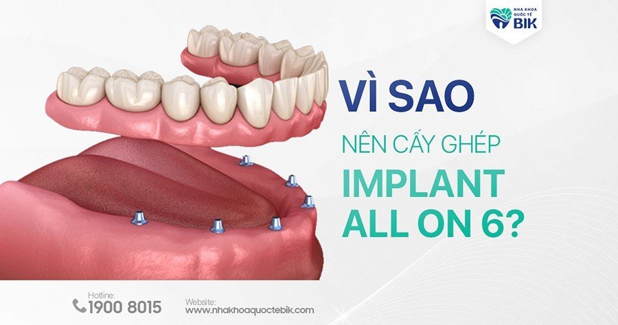 cay-ghep-implant-all-on-6-la-gi