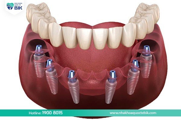 cay-ghep-implant-all-on-6-la-gi