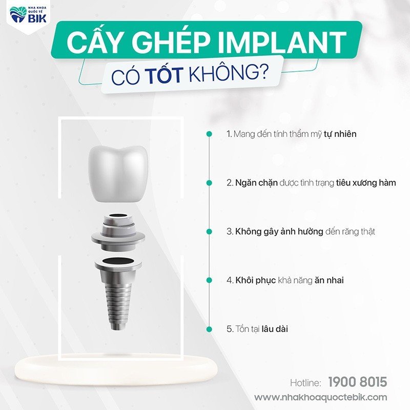 cay-ghep-implant-co-tot-khong