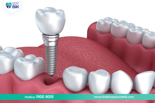 Cấy ghép implant phục hình răng cấm bị mất