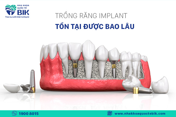 trong-rang-implant-ton-tai-duoc-bao-lau