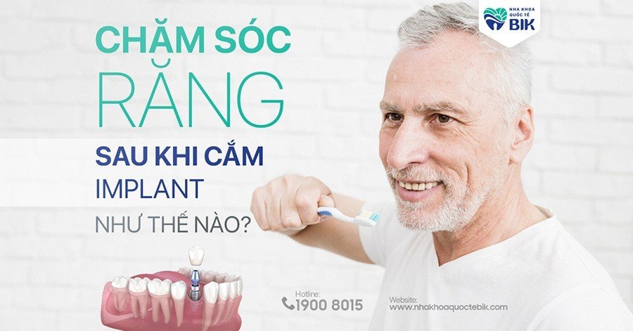 cham-soc-rang-sau-khi-cam-implant