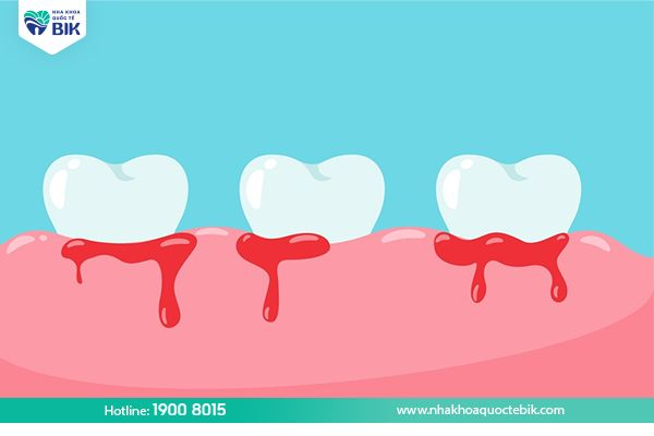 Bleeding gums and bad breath