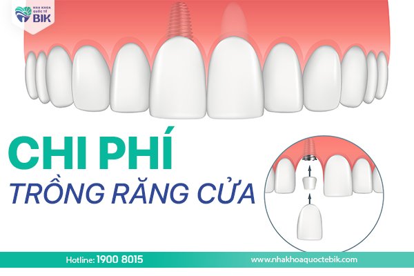 chi-phi-trong-rang-cua