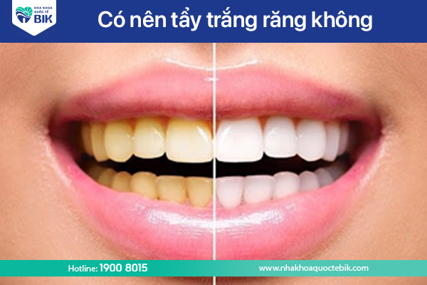 Có nên tẩy trắng răng không