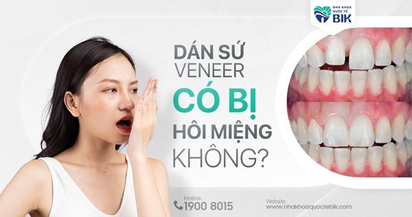 dan-su-veneer-co-bi-hoi-mieng-khong