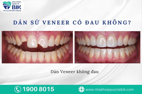 dan-su-veneer-co-dau-khong