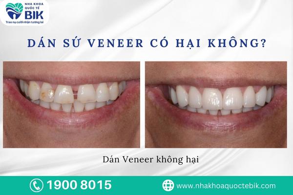 dan-su-veneer-co-hai-khong