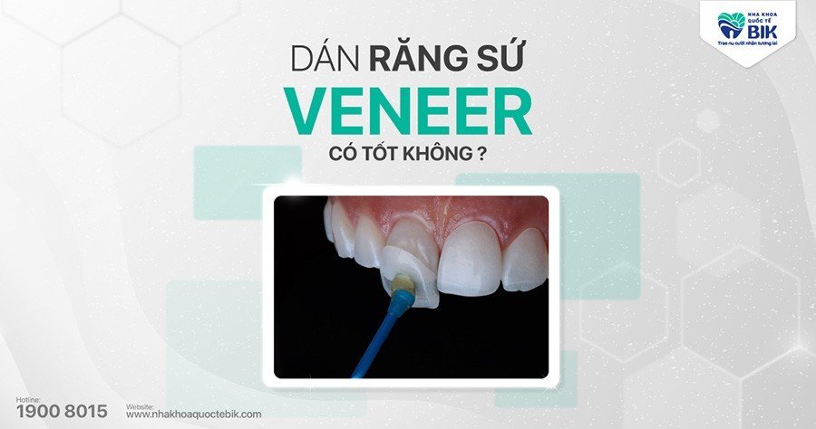 dan-rang-su-veneer-co-tot-khong