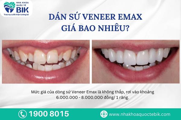 dan-su-veneer-emax-gia-bao-nhieu