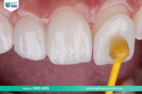 Veneer to treat tooth decay at the dentist