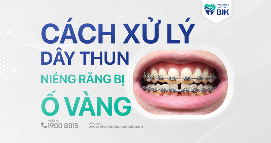 day-thun-nieng-rang-bi-vang