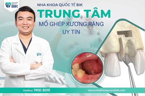 dia-chi-mo-ghep-xuong-rang-uy-tin