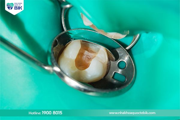 Root canal treatment for molar tooth decay