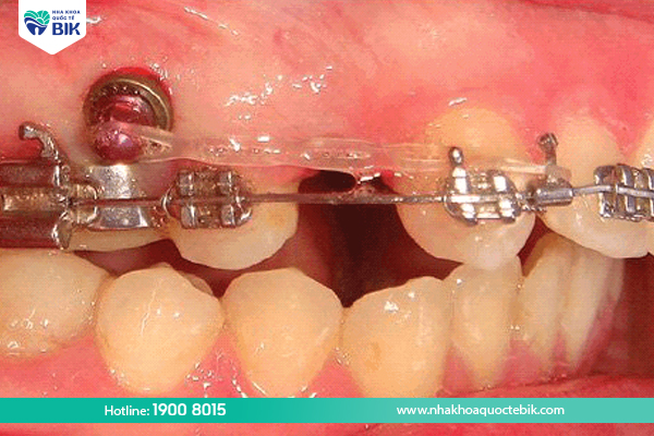 How long does it take to close the space in braces?