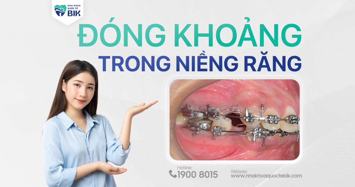 Đóng khoảng trong niềng răng