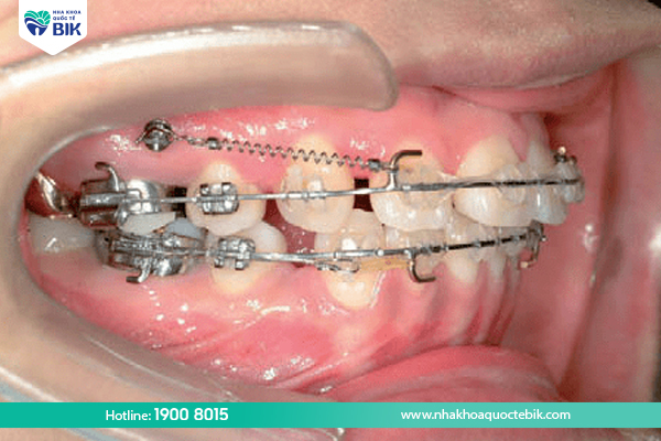 How does the braces space closing stage take place?