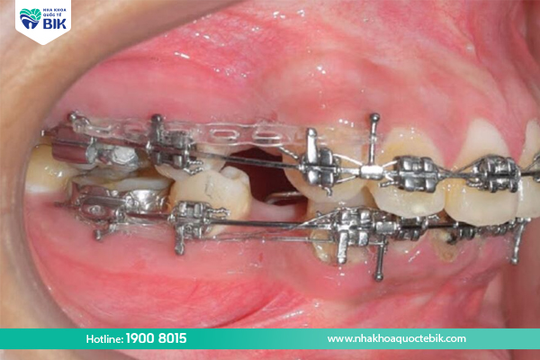 Spacing stage in braces