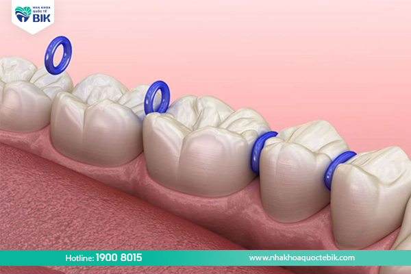 Straightening and aligning teeth phase