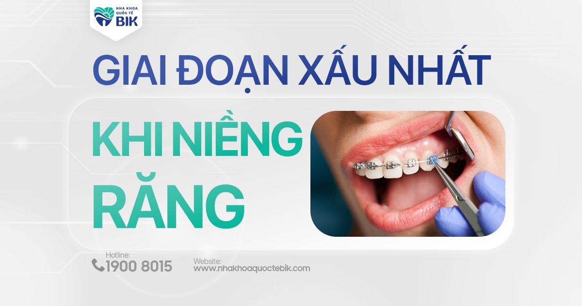 Giai đoạn xấu nhất khi niềng răng