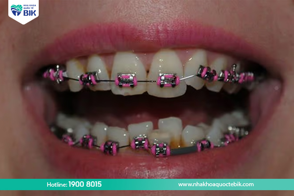 What is the worst stage when wearing braces?