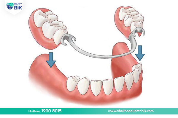 Removable dentures