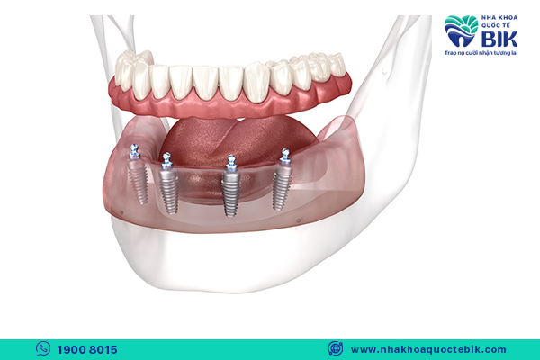 removable denture on implants