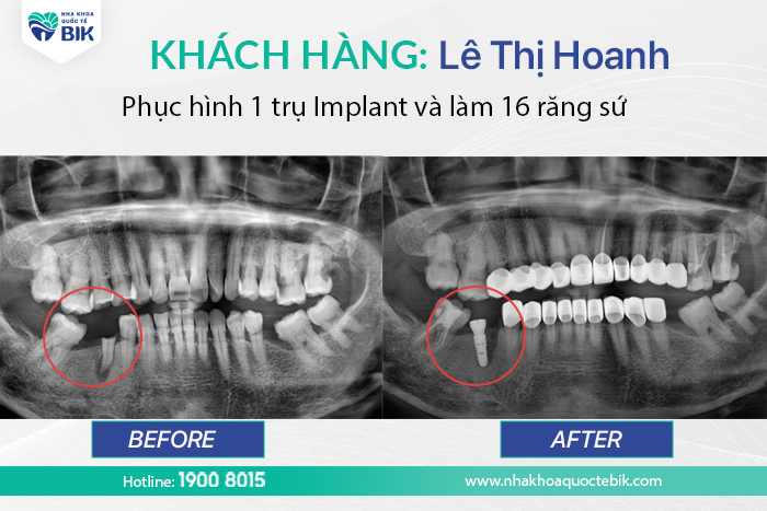 hinh-anh-truoc-va-sau-khi-trong-rang-implant