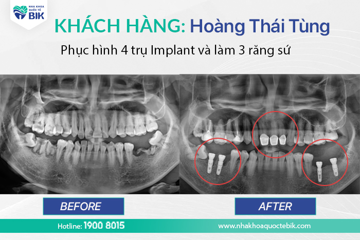 hinh-anh-truoc-va-sau-khi-trong-rang-implant