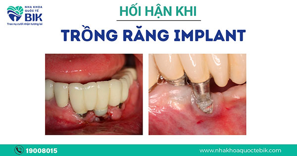 hoi-han-khi-trong-implant