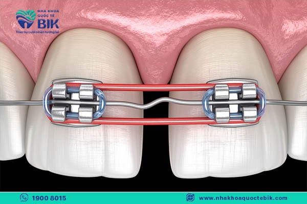 Does the tooth pulling phase when braces hurt?